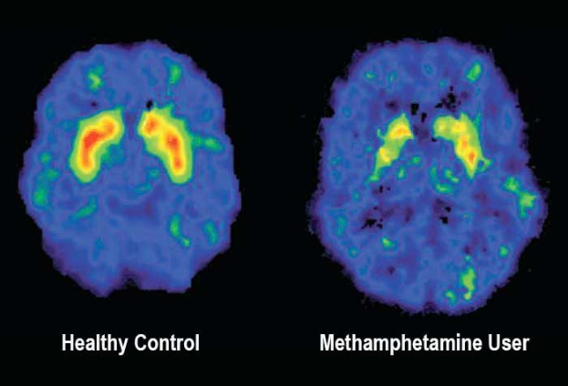 Zwei MRI-Gehirn-Scans nebeneinander, einer mit der Beschriftung "gesunder Kontroll" und der andere mit der Beschriftung "Methamphetamin-Nutzer" vor einem dunklen Hintergrund.